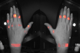 Demcon_hightech_handscan_outcome_inflammation